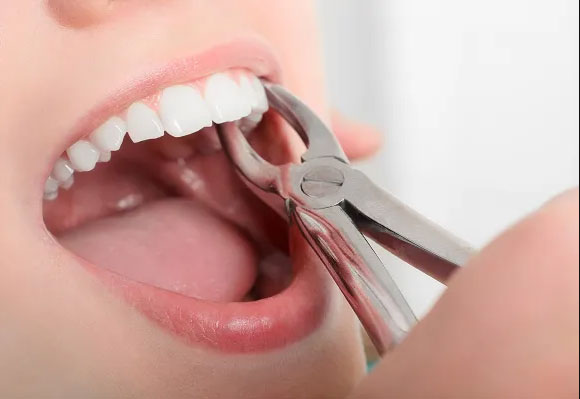 Wisdom Tooth or Tooth Extraction Wisdom Tooth or Tooth Extraction