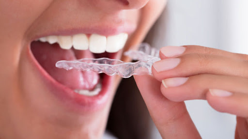 Mouth Guards-Night Guards Mouth Guards-Night Guards