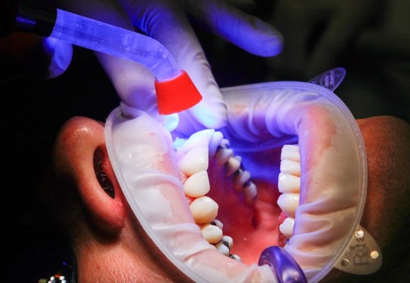 Dental treatment